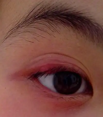 长针眼的症状图片 (17)_有来医生