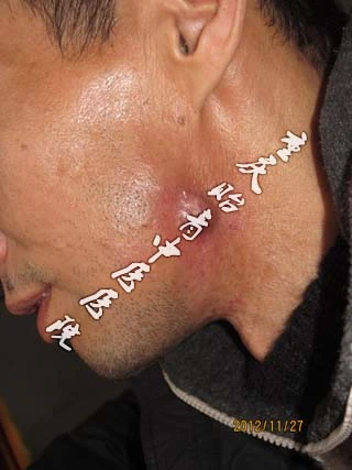 左下颌骨髓炎患者蒉先生左侧脸反复肿胀疼痛6月余,伴破溃流脓3月余