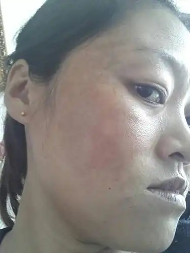 我的孕辰斑一年了,有办法去吗?