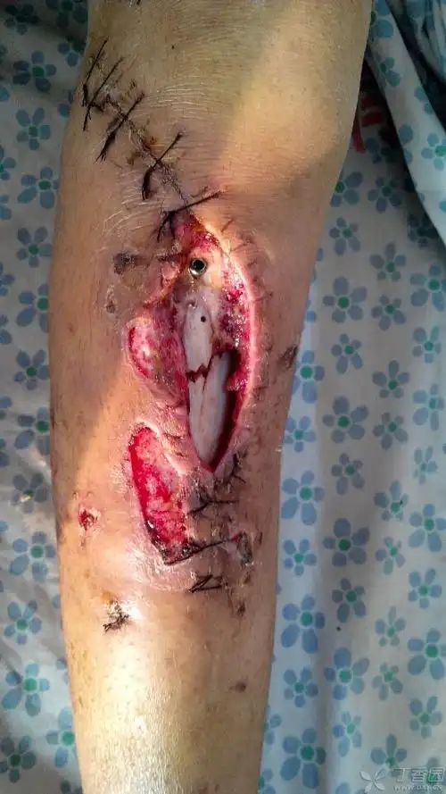 胫骨平台骨折术后伤口感染,软组织坏死. [病例帖]