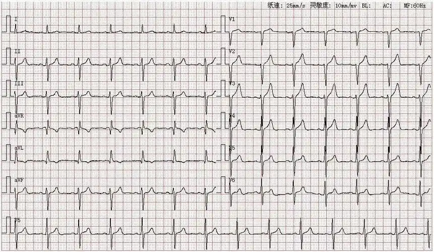 心电图图库丨左前分支阻滞系列