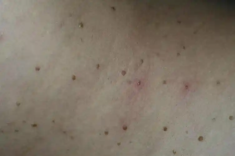 妻子染hpv不自知,1月后丈夫满身疣体,为何男人更严重?听医生怎么说_东