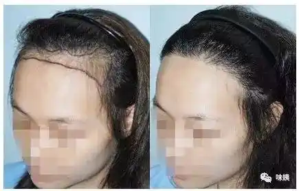 优点在于 一劳永逸,不用再担心画出来的发际线太假,或者容易脱妆,不敢