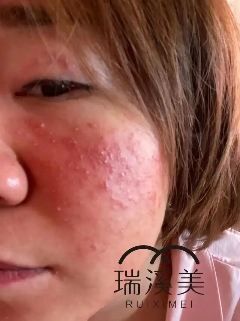 敏感性皮肤俗称敏感肌客观上可以观察到敏感性皮肤容易发红容易对外界