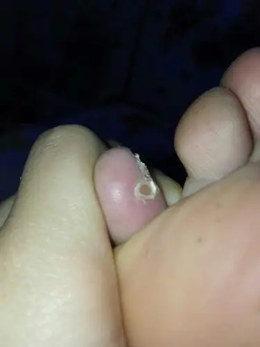 小脚趾左侧方长了个圆圆的,摸起来硬硬的,看起来有点像指甲?