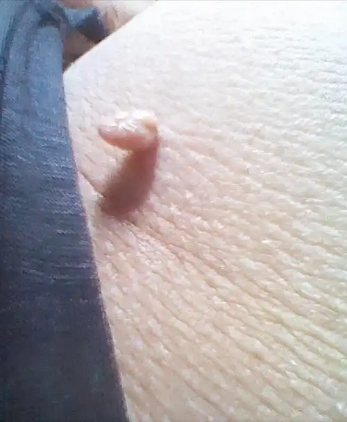 腋下长了个小肉粒图片(脖子上长了) - 赤虎壹号