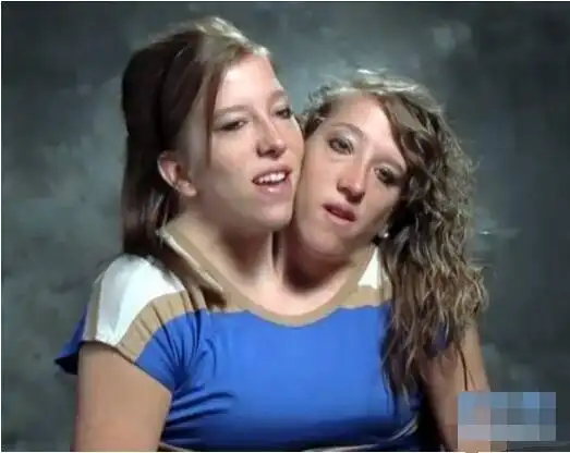 因为这个婴儿竟然是长有两个头,乃是世界罕见的双头人,医生并且断定