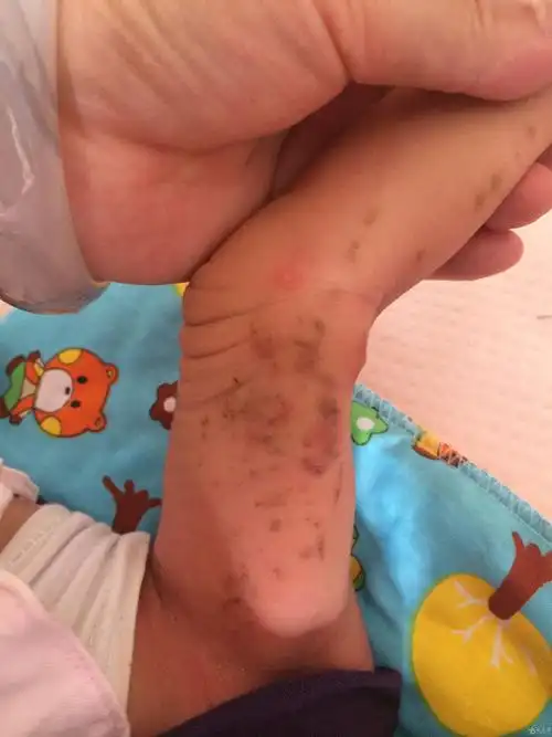 新生儿的单侧肢体带有斑片
