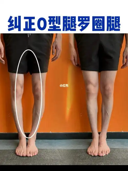 73纠正o型腿吹爆的直腿术