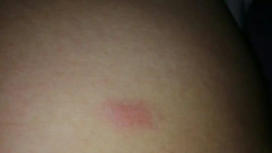 身上莫名其妙长了几个红疙瘩,很痒