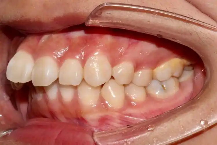 深圳牙齿矫正信蓓医生重度深覆合覆盖嘴突案例