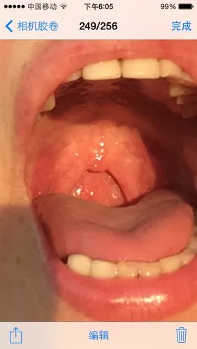 我的咽喉正常吗?