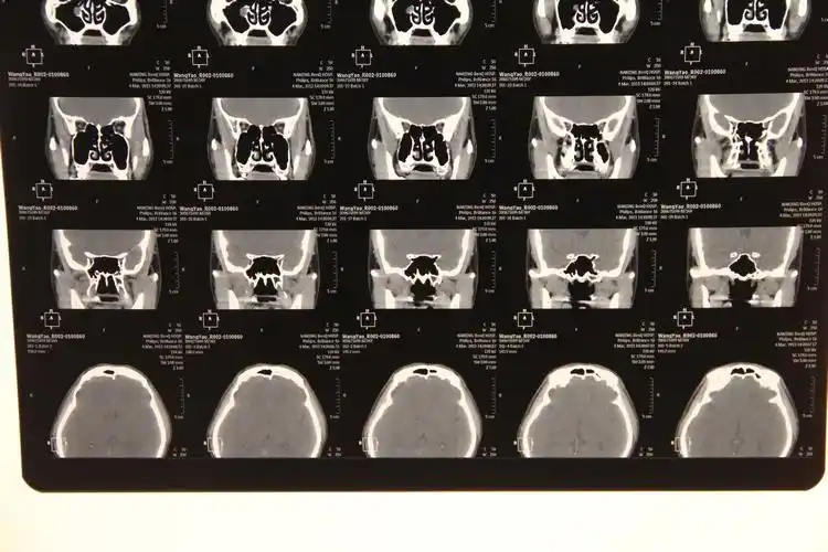 帮我看下这个ct图片,上颌窦里面有东西.现在鼻子很不舒服.