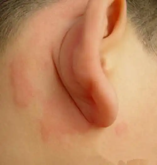 得了风疹的症状图片