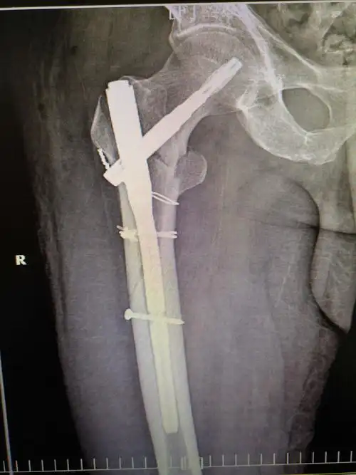 钛缆 pfna治疗老年股骨近端粉碎性骨折