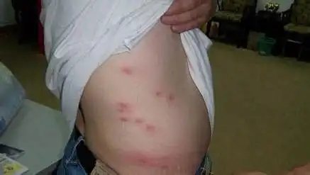 一但被虱子咬.狗血进如了人体.会不会有狂犬病啊?