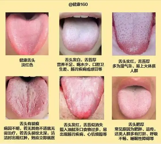 健康人的舌头,通常会呈现出淡红色且有一层薄白苔的表象,但若是亚健康