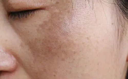 【脸色发黄是什么原因】肤色暗沉发黄怎么调理?这5个原因要注意!