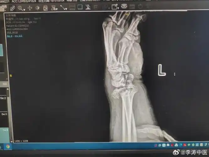 患者从3米高跌下造成桡骨下端呈爆裂状粉碎性骨折到过数家医院要切开