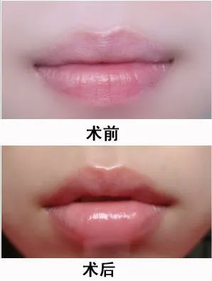 丰唇效果图明显吗_注射丰唇_整形频道_寻医问药网