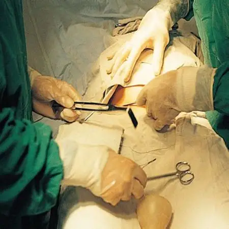 图解剖腹产手术全过程,胆小者勿入!