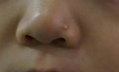 哪些皮肤表现需要高度警惕神经纤维瘤病?