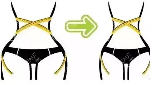 腹部吸脂前后对比图