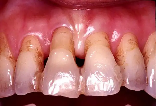 牙周病松动前牙固定术