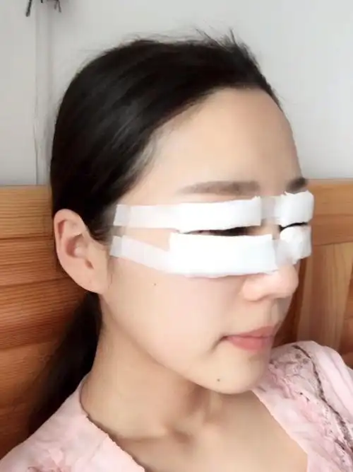 术后第1天眼睛还蒙着纱布就迫不及待的来记录恢复过程_圈子-新氧美容