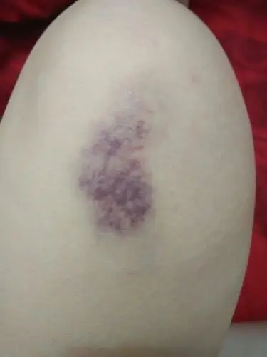 没有受伤,不疼,腿上怎么会有这么严重的淤青,不会有什么事吧?