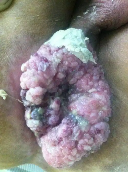 中期尖锐湿疣图片_有来医生