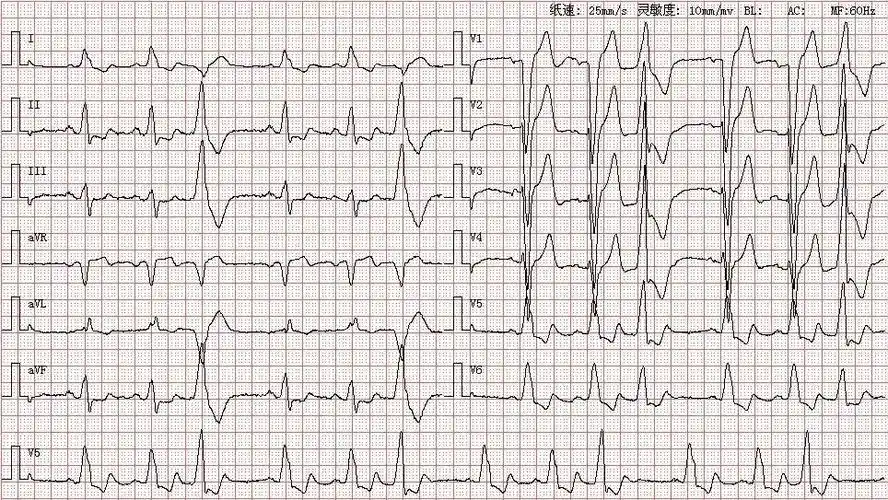 心电图图库丨完全性左束支阻滞系列
