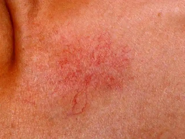 很多患上肝癌的人他们的皮肤上会出现红色的小点,这种红点其实叫作