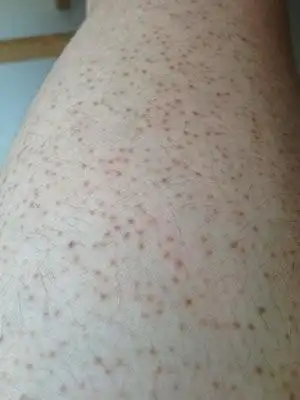 男性一期梅毒图片49