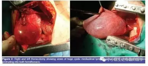 年轻人,胸水引流管放进心脏了:b超检查后仍被外国人误诊的胸水-搜狐大