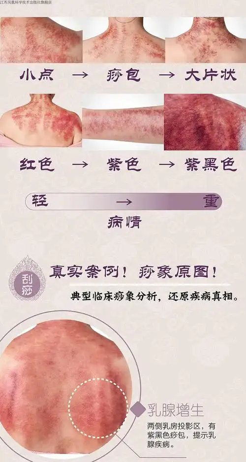 图解痧象零基础学刮痧 刮痧书籍刮痧板刮痧书籍 刮痧图解 刮痧拔罐