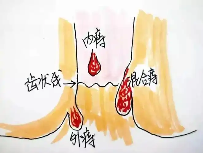 屁股痔疮流血怎么办 屁股内痔疮出血怎么办