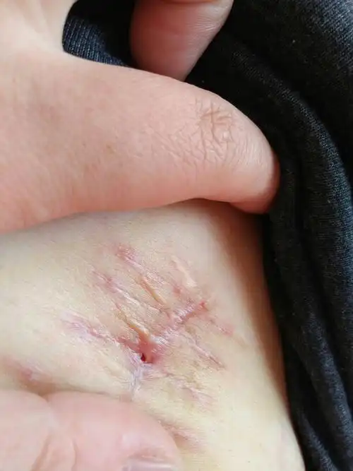 剖宫产22天刀口处有米粒大小洞,需要怎么治疗 快满月了能发汗吗