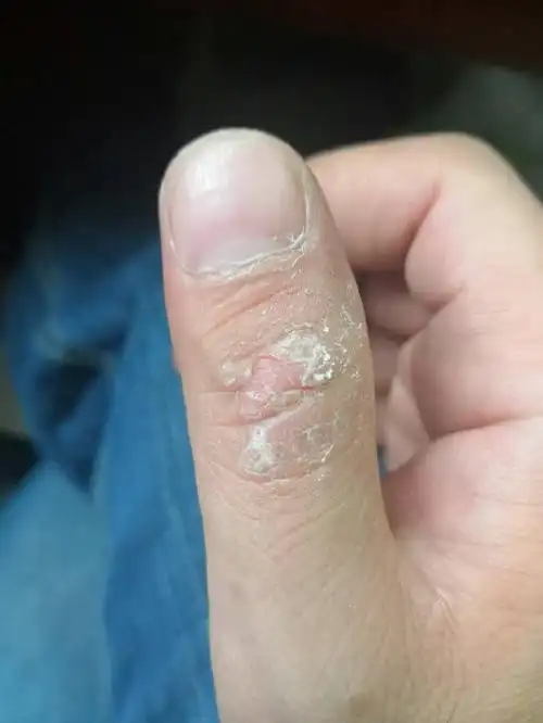 手指上出来的这是什么癣?