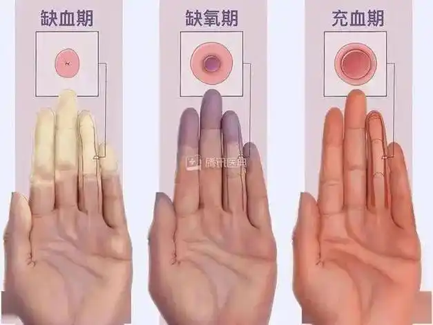 雷诺氏综合征和雷诺现象有什么区别