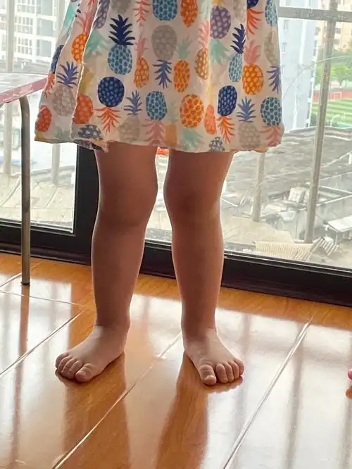 两岁小朋友这个腿型正常吗