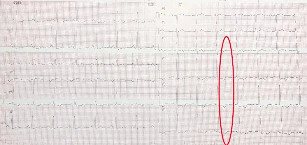 心电图t波改变是怎么回事儿?就是冠心病吗?