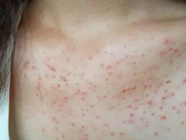 螨虫皮炎胸部密密麻麻的小红疙瘩图