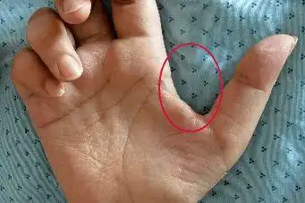 渐冻症当肌萎缩与肉跳同框说明什么