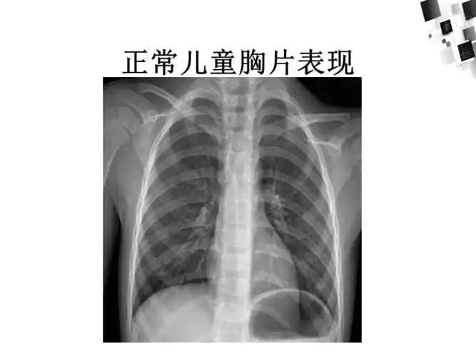 儿童常见肺部感染ppt课件