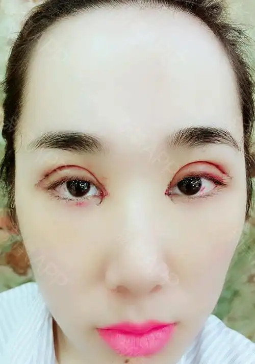 氧气xv77g切开双眼皮第6天美丽日记