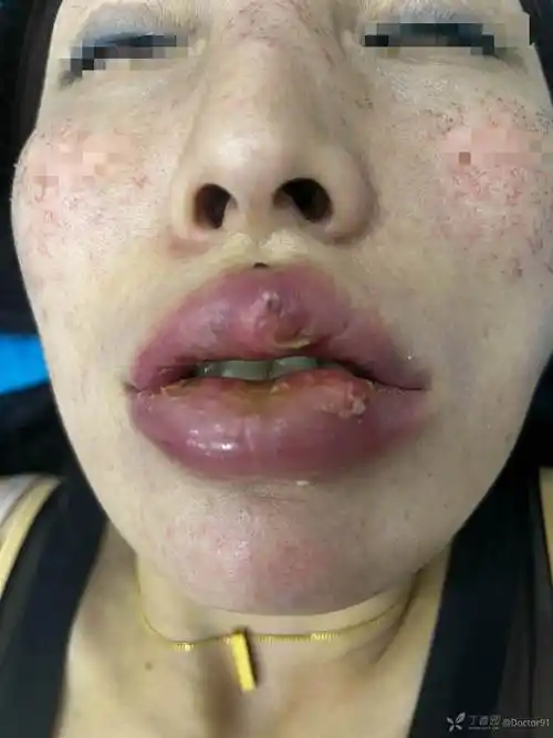 玻尿酸丰唇1月后出现唇痈一例