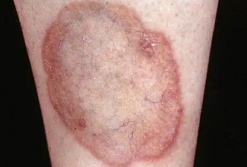 皮肤发出的8大癌症信号 你小心了没?