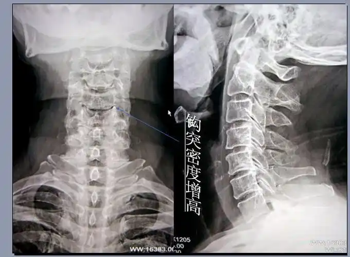 钩椎关节的介绍
