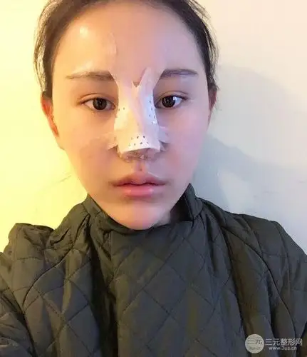 鼻部手术图片:隆鼻1-7天恢复期真实案例,前后对比照片分享~_三元整形